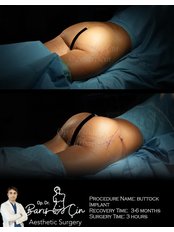 Butt Implants - Dr. Baris Cin