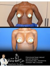 Breast Implant Revision - Dr. Baris Cin