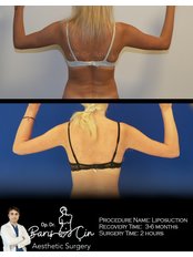 Arm Liposuction - Dr. Baris Cin