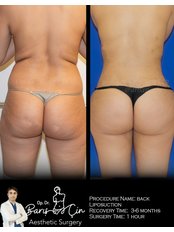 Back Liposuction - Dr. Baris Cin