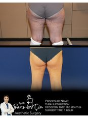 Thigh Liposuction - Dr. Baris Cin