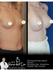 Breast Implants - Dr. Baris Cin