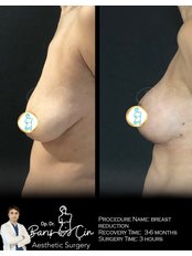 Breast Reduction - Dr. Baris Cin