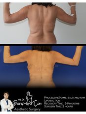 Arm Liposuction - Dr. Baris Cin