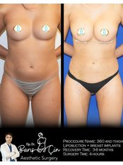 Thigh Liposuction - Dr. Baris Cin