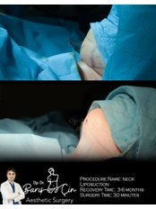 Neck Liposuction - Dr. Baris Cin