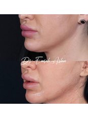 Double Chin Surgery - Dr Emrah Aslan Clinic