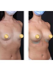 Breast Implants - Dr Emrah Aslan Clinic