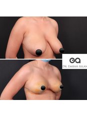 Breast Lift - Dr Emrah Aslan Clinic