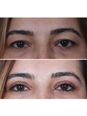Eyelid Surgery - Dr Emrah Aslan Clinic