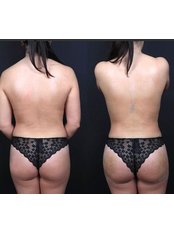 BBL - Brazilian Butt Lift - Dr Emrah Aslan Clinic