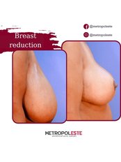 Breast Reduction - Metropolmed