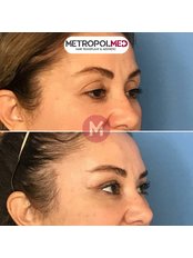 Eyelid Surgery - Metropolmed