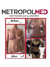 Breast Implant Revision - Metropolmed