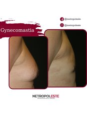 Gynecomastia - Metropolmed