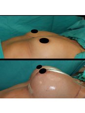 Breast Implants - Panafhealth
