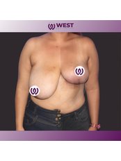 Breast Lift - West Aesthetics - Turkey