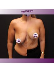 Breast Lift - West Aesthetics - Turkey