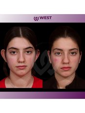 Otoplasty - West Aesthetics - Turkey