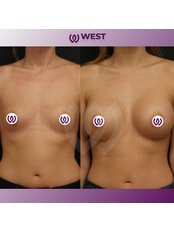 Breast Implants - West Aesthetics - Turkey