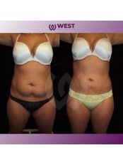 Liposuction - West Aesthetics - Turkey
