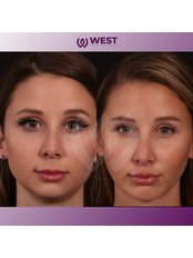 Buccal Fat Removal - West Aesthetics - Turkey