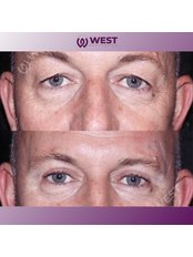 Blepharoplasty - West Aesthetics - Turkey