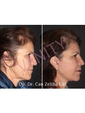 Facelift (Face &Neck) - Vanity Cosmetic Surgery Hospital İstanbul