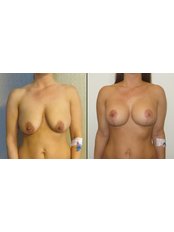 Breast Lift - Vanity Cosmetic Surgery Hospital İstanbul