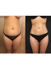 Liposuction (One Area) - Vanity Cosmetic Surgery Hospital İstanbul