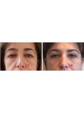 Eyelid Surgery (Full) - Vanity Cosmetic Surgery Hospital İstanbul