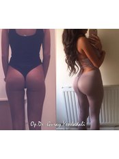 Butt Implants - Vanity Cosmetic Surgery Hospital İstanbul