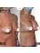 SurgeryTR - Istanbul - Breast Implant 