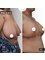 SurgeryTR - Istanbul - Breast Reduction 