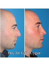 Rhinoplasty - Assoc. Dr. Fatih Uygur / Plastic Reconstructive and Aesthetic Clinic