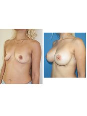 Breast Implants - Assoc. Dr. Fatih Uygur / Plastic Reconstructive and Aesthetic Clinic