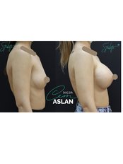 Breast Implants - Assoc. Prof. Dr Cem Aslan Clinic