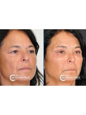 Eyelid Surgery - Candan Mezili Clinic
