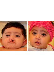Cleft Lip and Palate Treatment - Candan Mezili Clinic