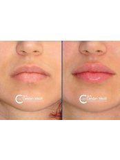 Lip Augmentation - Candan Mezili Clinic