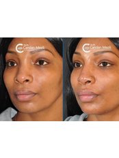 Chin Augmentation - Candan Mezili Clinic