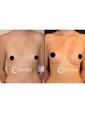 Breast Implants - Candan Mezili Clinic