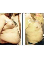 Liposuction - Candan Mezili Clinic