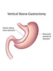 Gastric Sleeve - Clinic Away