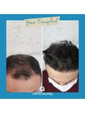 Hair Transplant - Clinic Away