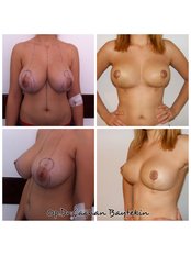 Brustverkleinerung - Clinic Baytekin