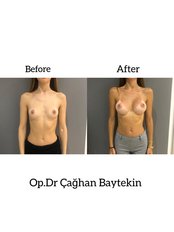 Brustvergrößerung - Clinic Baytekin