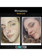 Rhinoplasty - Clinicton