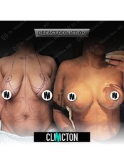 Breast Reduction - Clinicton