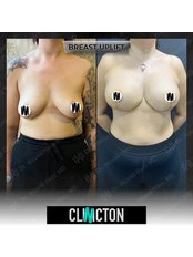 Breast Lift - Clinicton